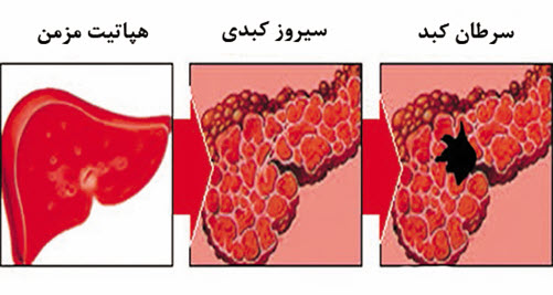 سیروز كبدی
